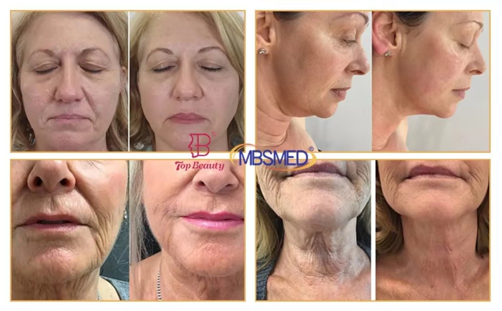 12D HIFU Treatment Before and After