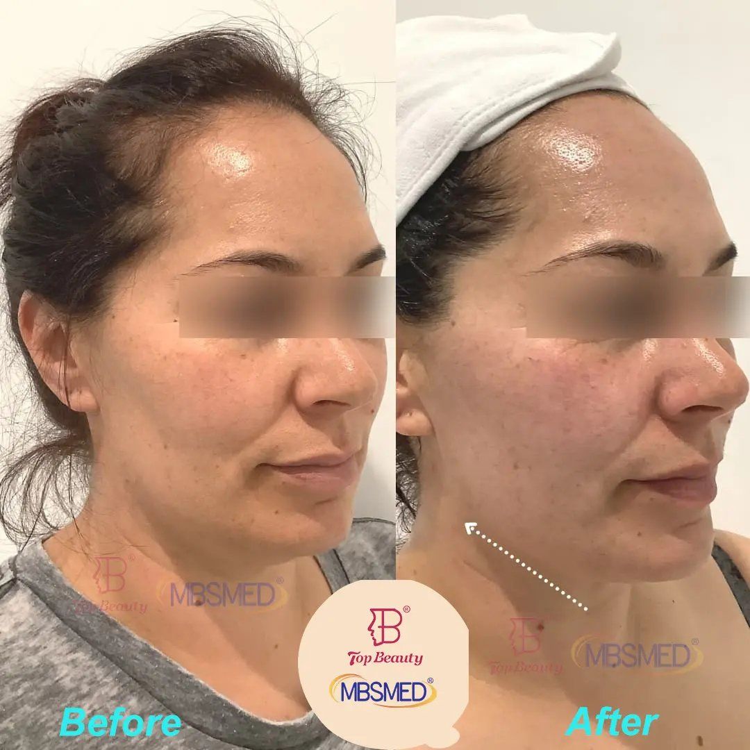 HIFU Treatment Coverage