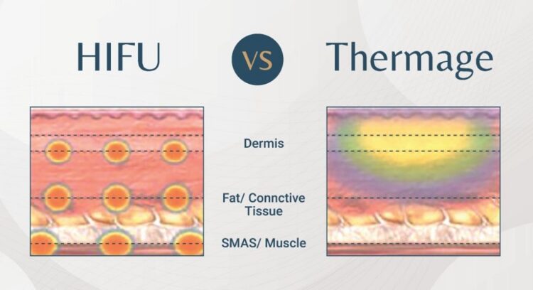 Thermage vs HIFU