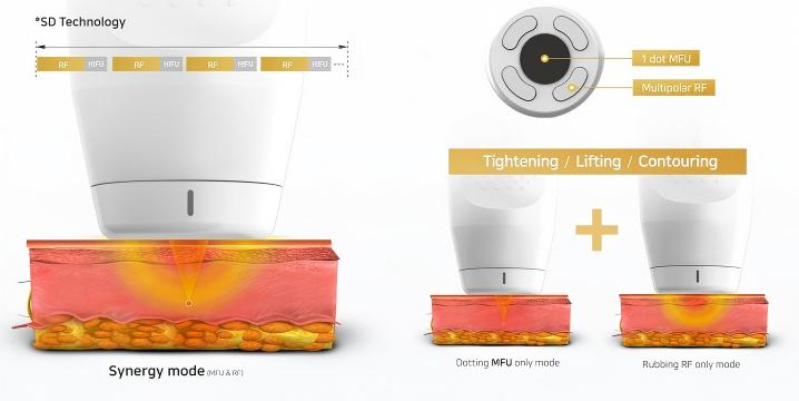Synergy of VMAX HIFU and RF