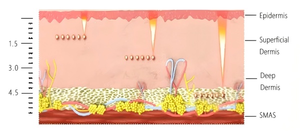 How Does 5D HIFU Work?