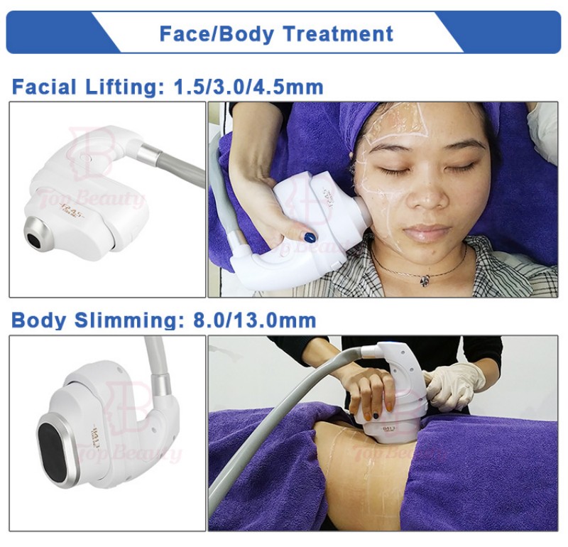5D Ice HIFU Machine Treatment