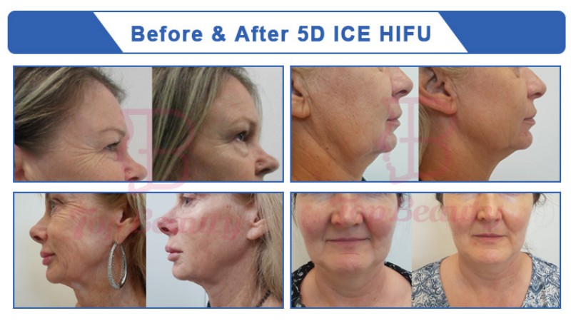 Before & After 5D ICE HIFU