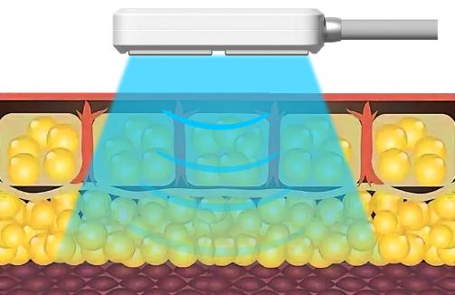 Cryo fat reduction