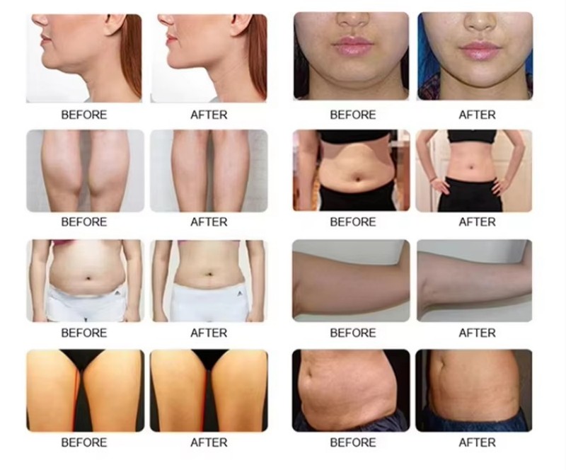 Cryo EMS Machine Before and After Result