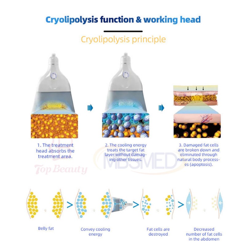 V12 Cryolipolysis principle