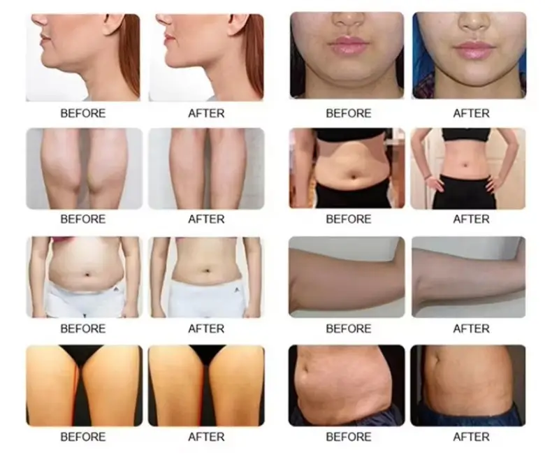 360 Cryolipolysis Machine Before and After Result