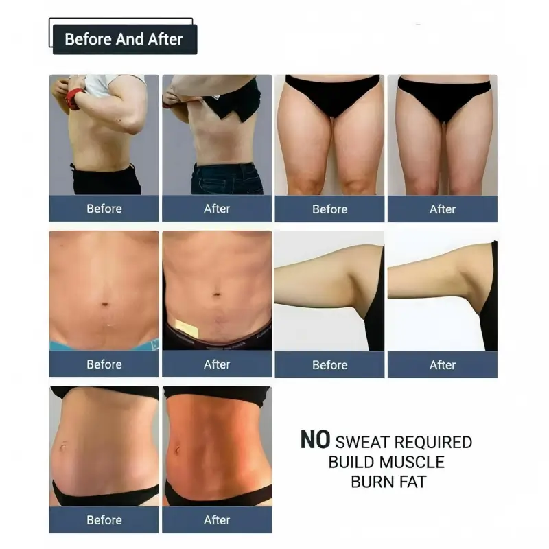 EMSculpt Machine for Home Use Before and After Treatment