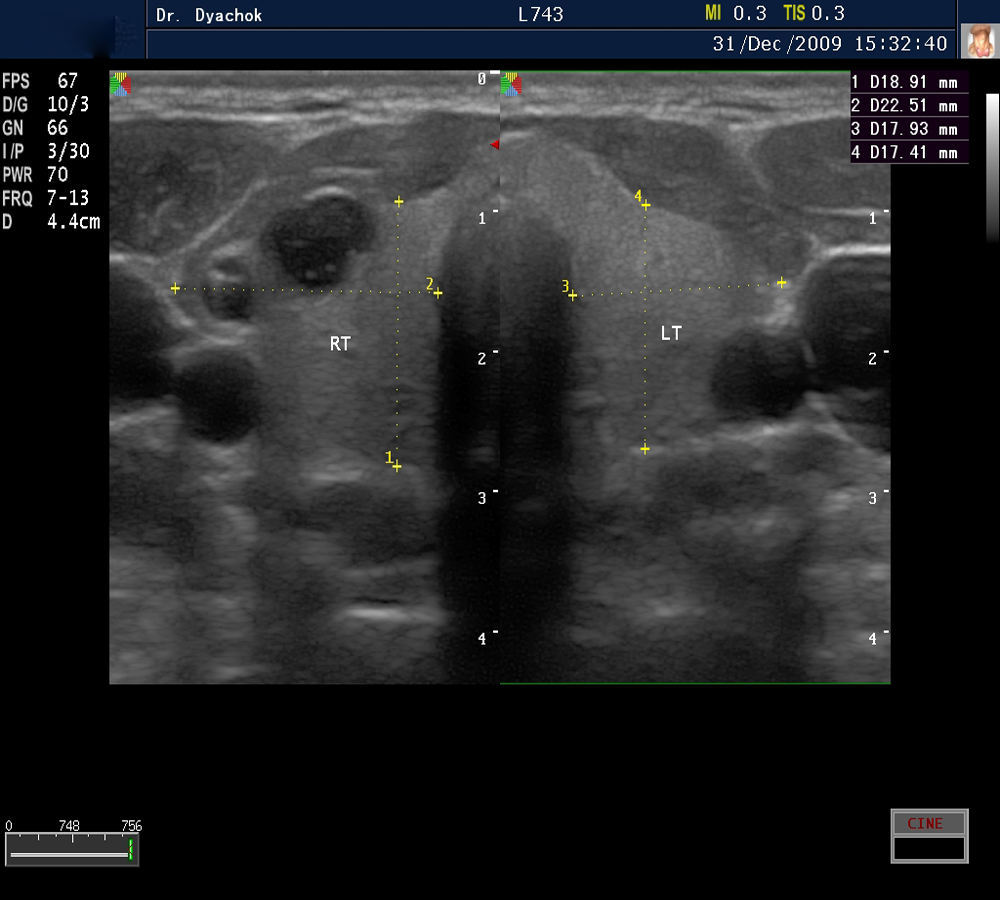 Laptop Color Doppler Ultrasound System  SonoScape S8Exp