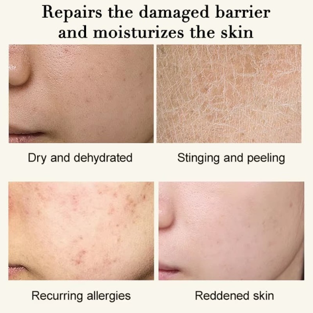 Emergency Soothing Facial Serum, Calming Redness & Hydrating Sensitive Irritated Skin Serum,Emergency Soothing Facial Serum, Calming Redness & Hydrating Sensitive Irritated Skin Serum 
