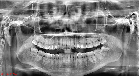 Dental computed tomography X-ray scanning system