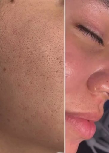 HONKON RF Micro needling WZ02-Plus