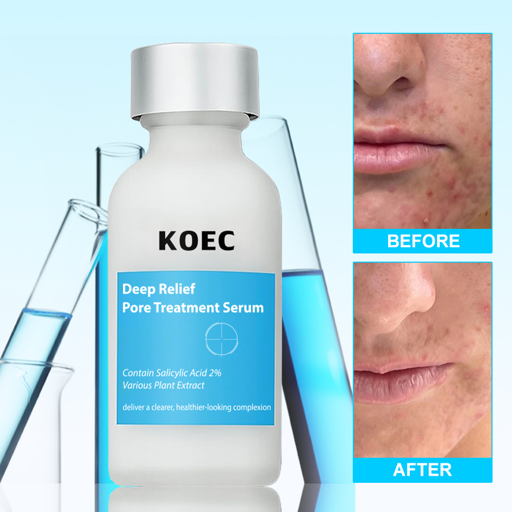 Deep Relief Pore Treatment Serum KOEC Powerful Phytosteroid Treatment Heals Deep Uncomfortable Acne Accept Custom Private Logo