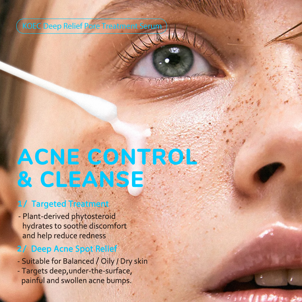 Deep Relief Pore Treatment Serum KOEC Powerful Phytosteroid Treatment Heals Deep Uncomfortable Acne Accept Custom Private Logo