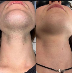 Appareil IPL SHR Professionnel | Épilation Définitive et Rajeunissement Cutané