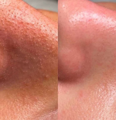 Hydra Skincare  – Machine de soin du visage 9-en-1 professionnelle