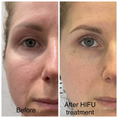 Fusion HIFU Machine - Technologie Avancée de Rajeunissement de la Peau | Emmalaser