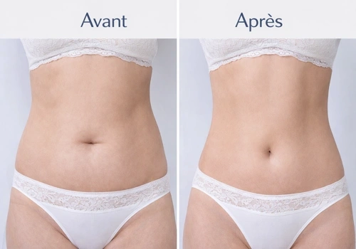 Cellusphere Roller® – Machine Anti-Cellulite & Drainage Lymphatique