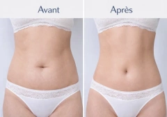 Cellusphere Roller® – Machine Anti-Cellulite & Drainage Lymphatique