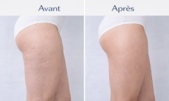 Cellusphere Roller® – Machine Anti-Cellulite & Drainage Lymphatique