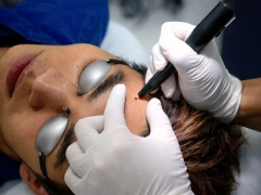Laser CO2 fractionné pour resurfaçage cutané profond et renouvellement cellulaire