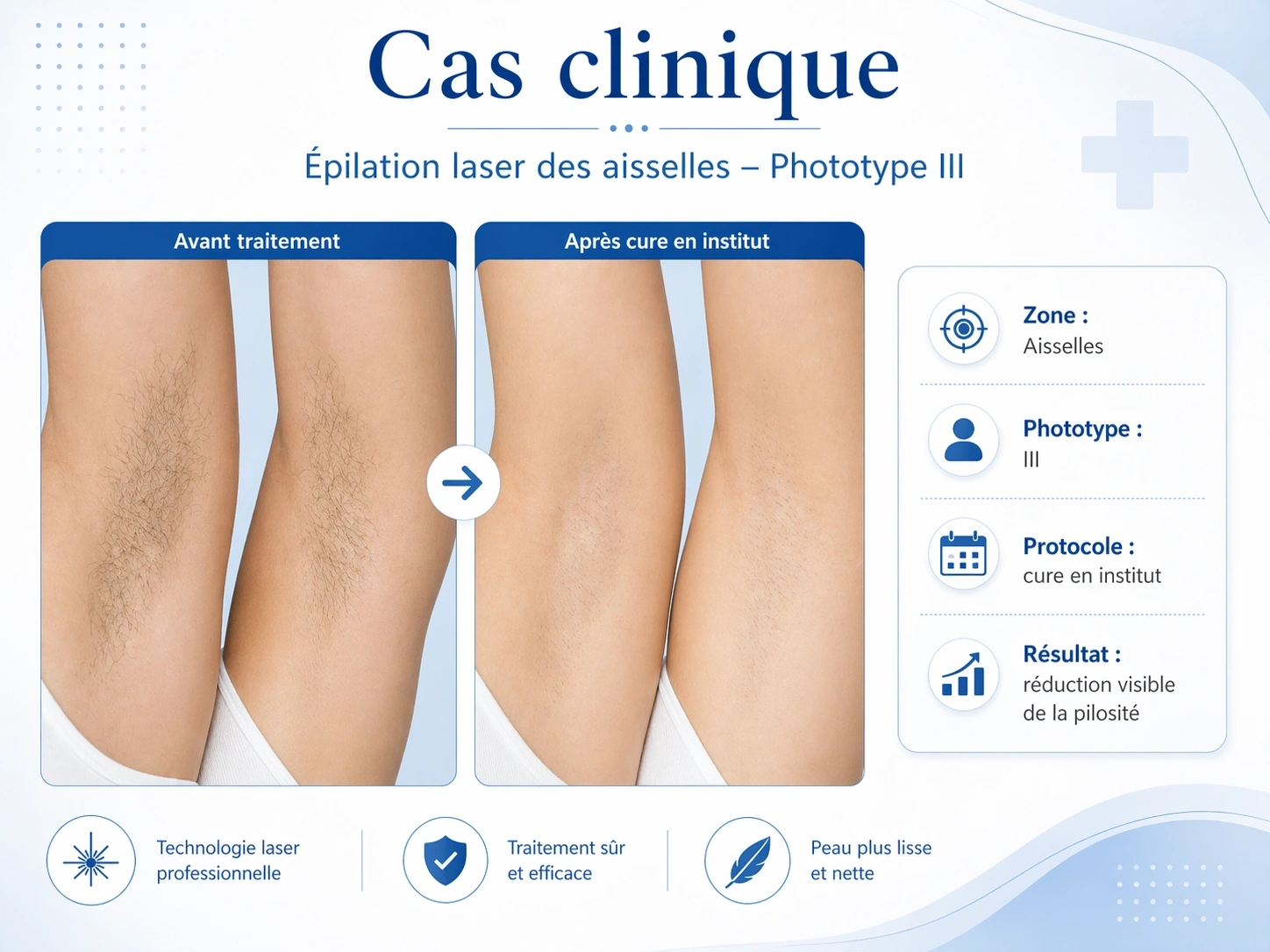 EPYLASE – Appareil Professionnel d’Épilation Laser 1000–2000W | Résultats Durables