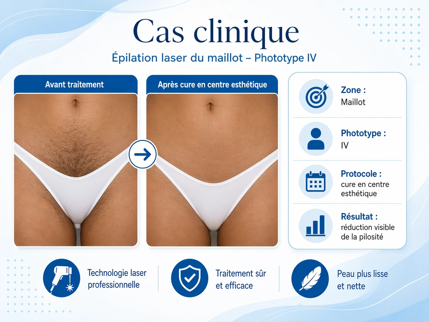 EPYLASE – Appareil Professionnel d’Épilation Laser 1000–2000W | Résultats Durables