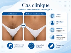 EPYLASE – Appareil Professionnel d’Épilation Laser 1000–2000W | Résultats Durables