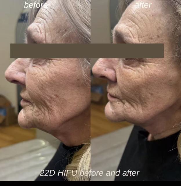 Résultat lifting du visage avec la machine 22D HIFU Max pour une peau plus ferme et plus jeune