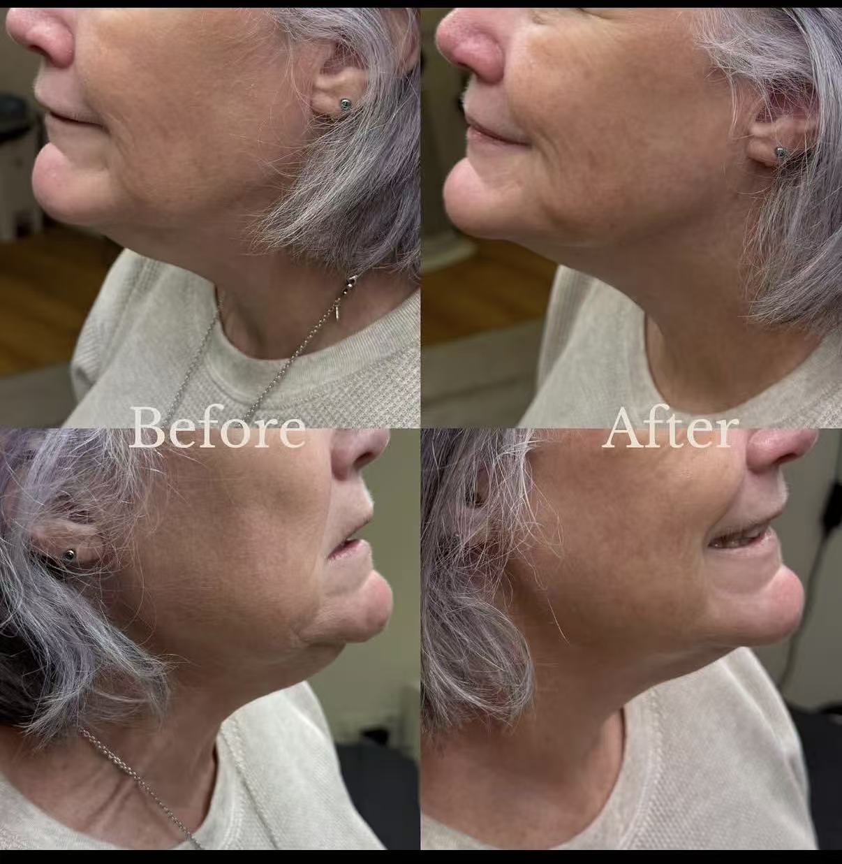 Effet raffermissant du 22D HIFU Max pour lifting facial et amélioration de l’élasticité de la peau