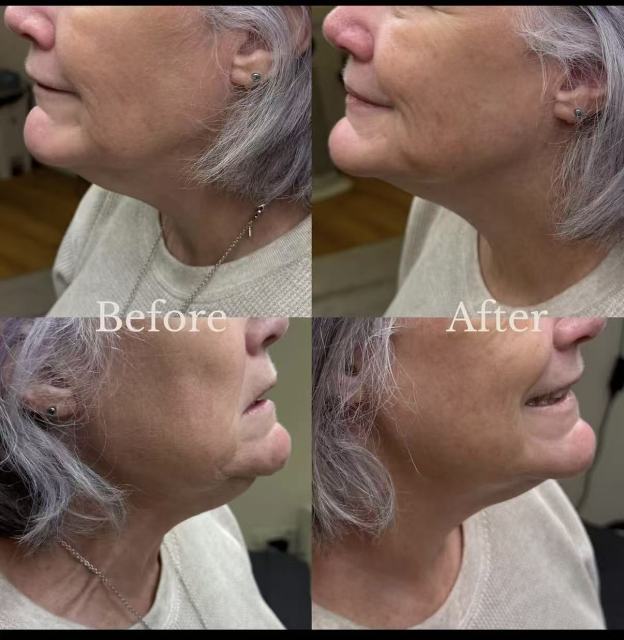 Effet raffermissant du 22D HIFU Max pour lifting facial et amélioration de l’élasticité de la peau