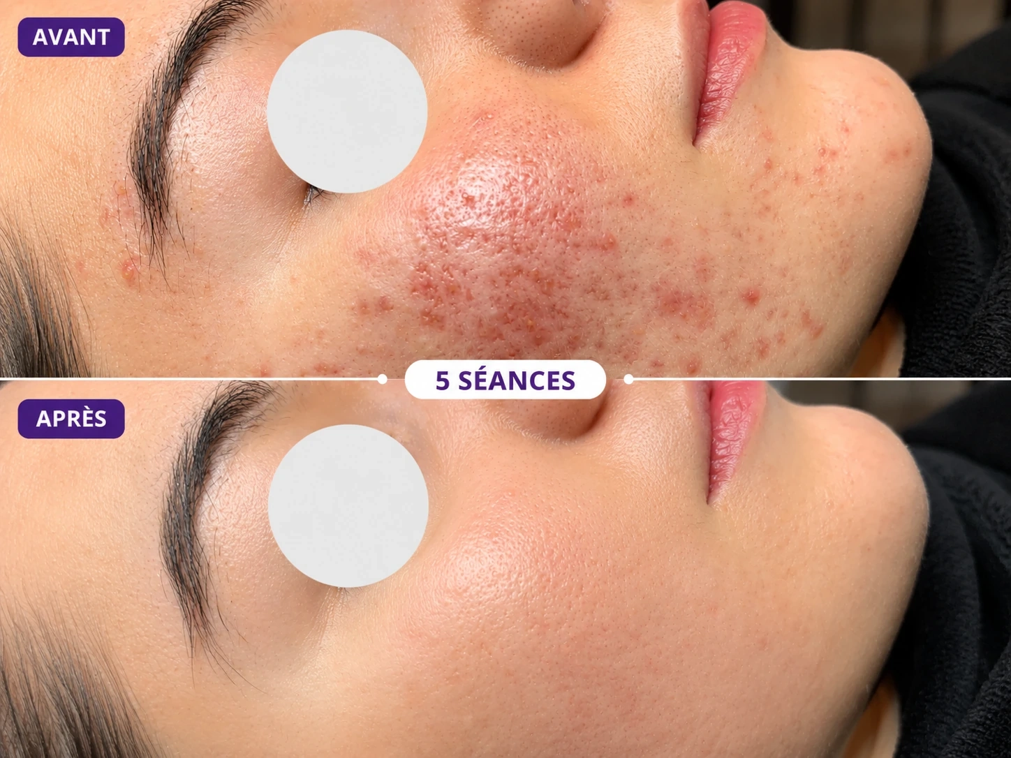 Avant après acné 5 séances, amélioration visible des imperfections, rougeurs et texture de peau.