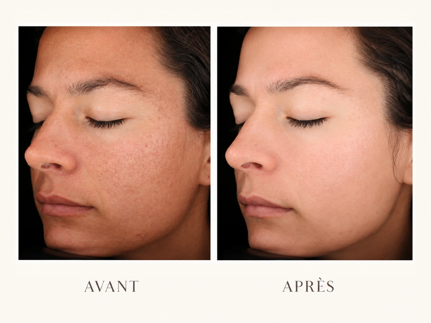 Avant après amélioration de la texture de peau, teint plus uniforme, peau plus lisse et plus éclatante.