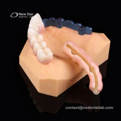 Hybrid Implant Denture Restorations