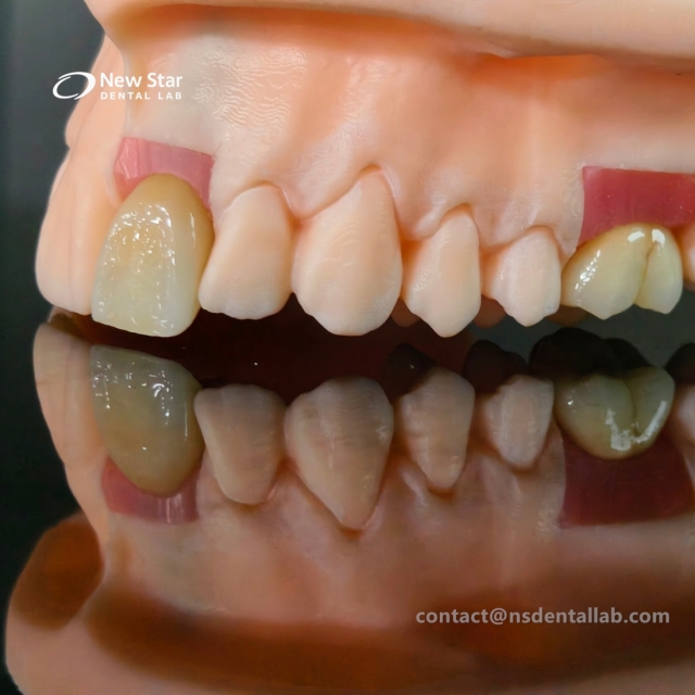 Implant Crown And Bridge Restorations
