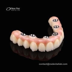 Full Arch Implant Denture Restorations