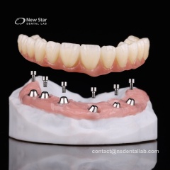 All-on-X Implant Solutions