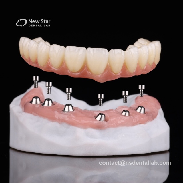 All-on-X Implant Solutions