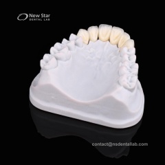 PFZ Crown (Porcelain Fused to Zirconia)