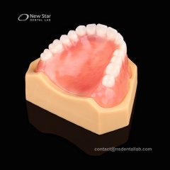 Full Denture Restorations