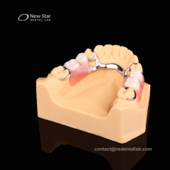 Partial Denture Restorations