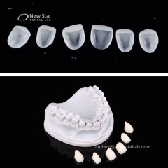 Emax Crown Veneer Restorations