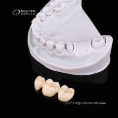 Zirconia Bridge Restorations