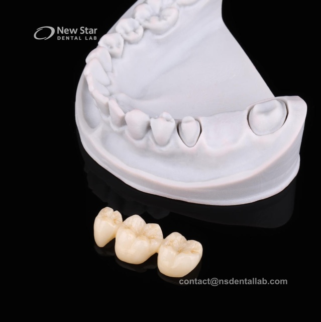 Zirconia Bridge Restorations