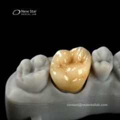 Full Zirconia Crown Restorations