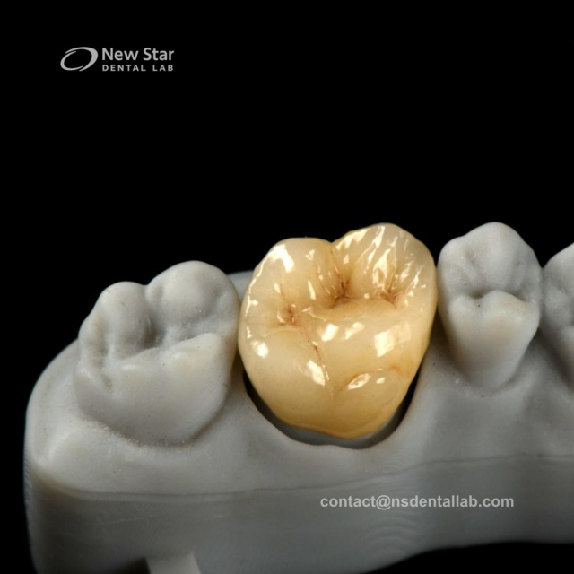 Full Zirconia Crown Restorations