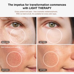 Factory Skin Care Face Led Therapy Red Blue Green Photon Infrared Light Face Massager Acne Treatment Device Laser Eye Surgery