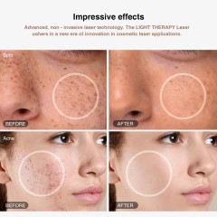 Factory Skin Care Face Led Therapy Red Blue Green Photon Infrared Light Face Massager Acne Treatment Device Laser Eye Surgery