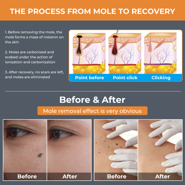 Factory Electric Plasma Pen Skin Mole Removal Facial Wart Label Tattoo Removal Tool