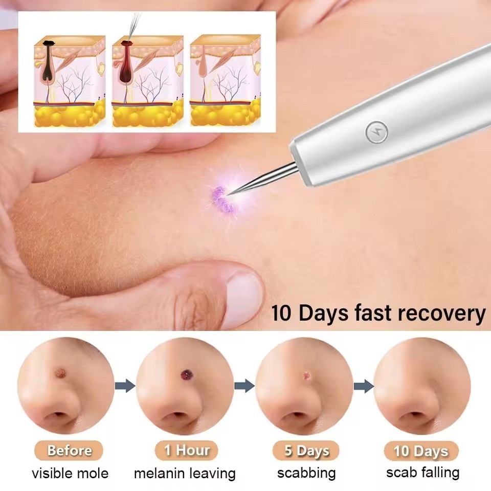 Dark Spot Mole Wart Remover Pen Skin Tag Remover Laser Plasma Pen for Skin Tag Remover